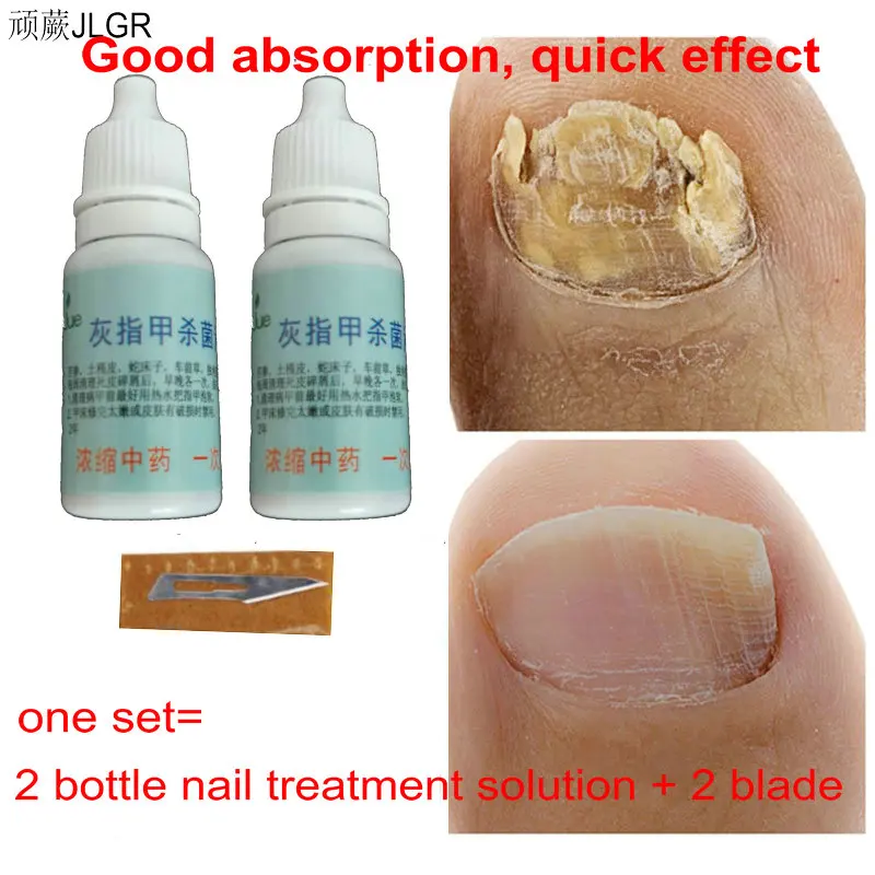 Купить Алиэкспресс Ointment for nail fungus Treatment remedy Foot