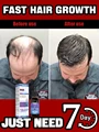 98% of buyers buy again, have more and more hair, say goodbye to baldness, thick hair,Hot selling product.